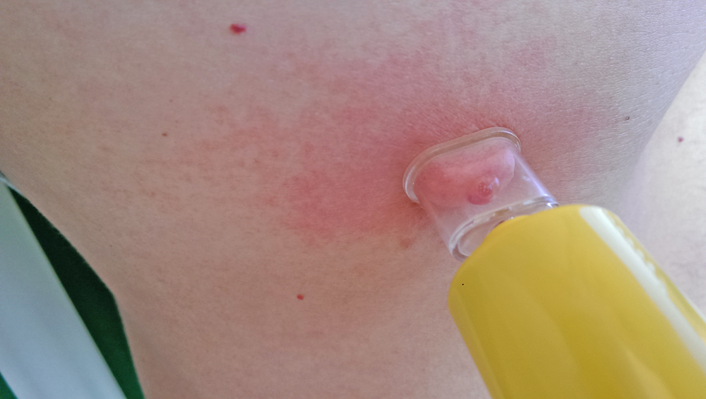 Екстрактор Sawyer The Extractor Pump Kit 7