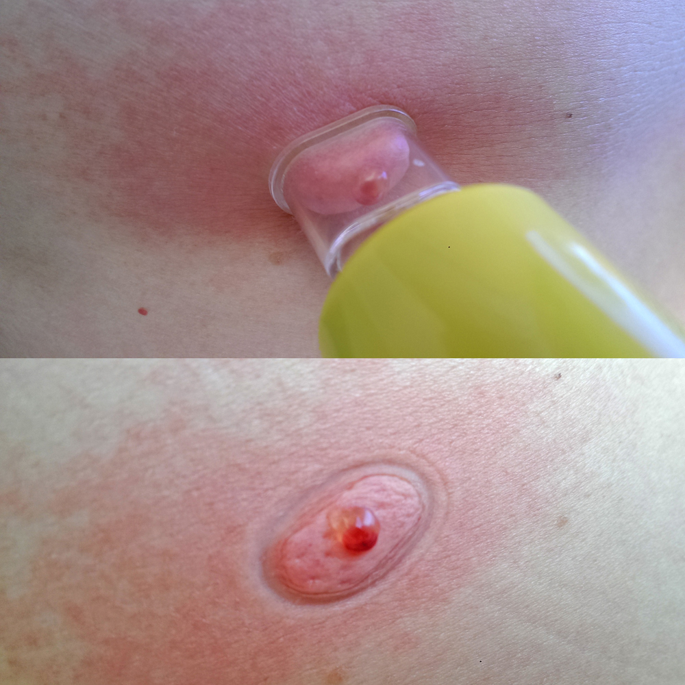 ЕКСТРАКТОР ПОМПА - комплект за извличане на отрова Extractor Pump Kit 4